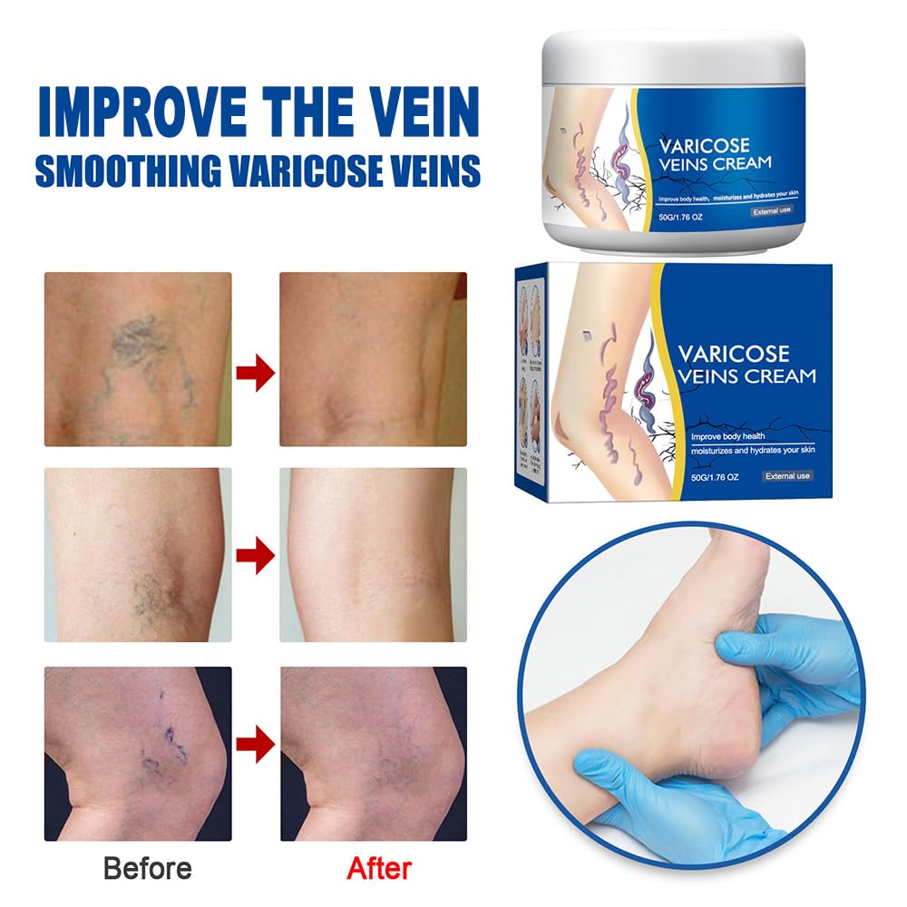Varicose Veins Cream for Legs, Spider Varicose Veins Cream, Skin Creams for Legs Treatment