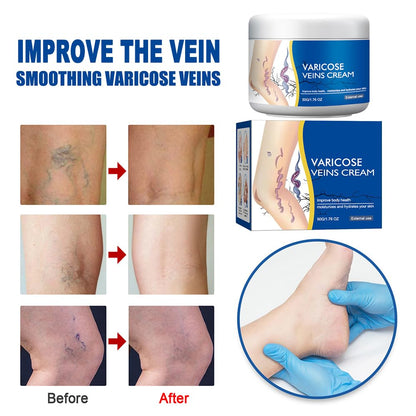 Varicose Veins Cream for Legs, Spider Varicose Veins Cream, Skin Creams for Legs Treatment