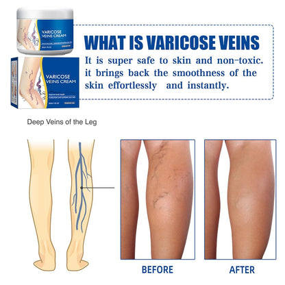 Varicose Veins Cream for Legs, Spider Varicose Veins Cream, Skin Creams for Legs Treatment